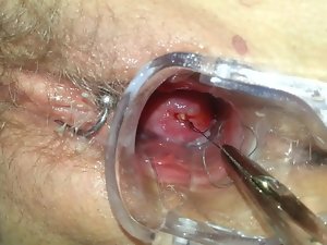 Mirena Spirale ziehen ہٹانے آئیوڈی IUP entfernen